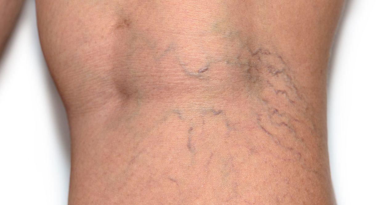 spider veins on a woman's ankle