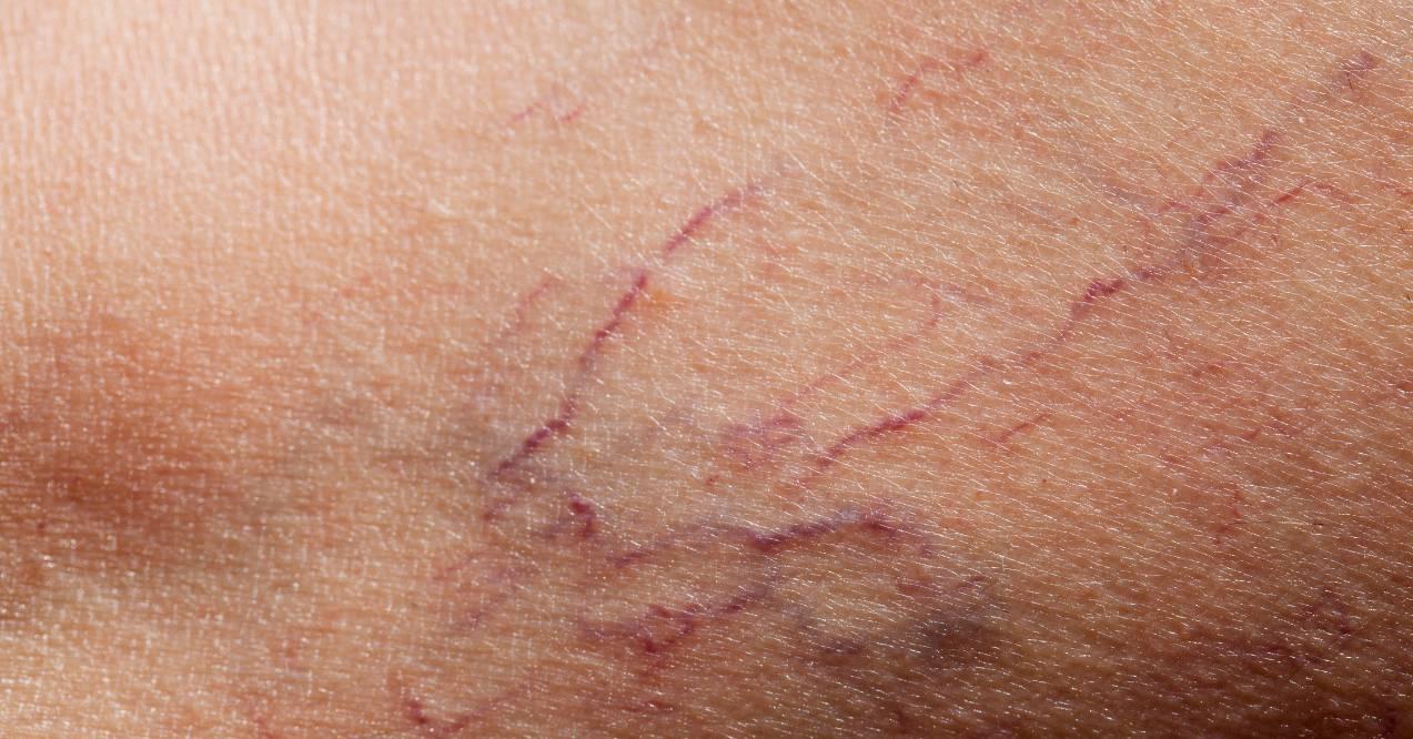 spider veins on face common causes and treatments