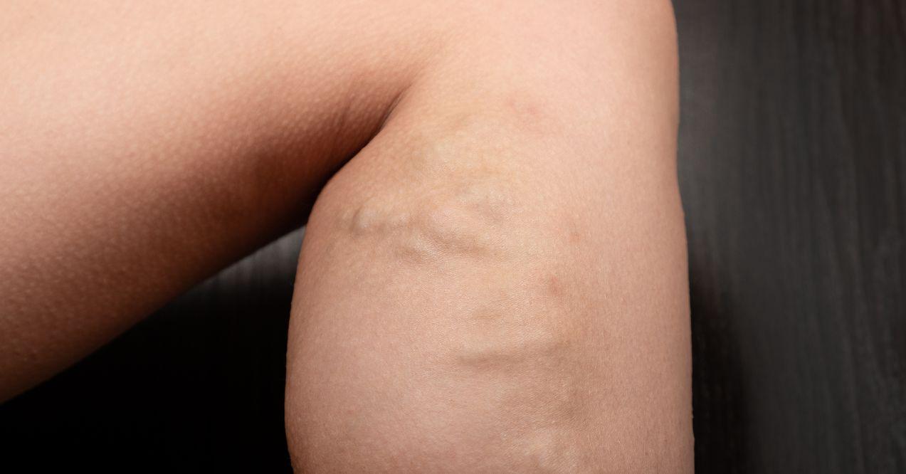varicose veins on a woman's shin