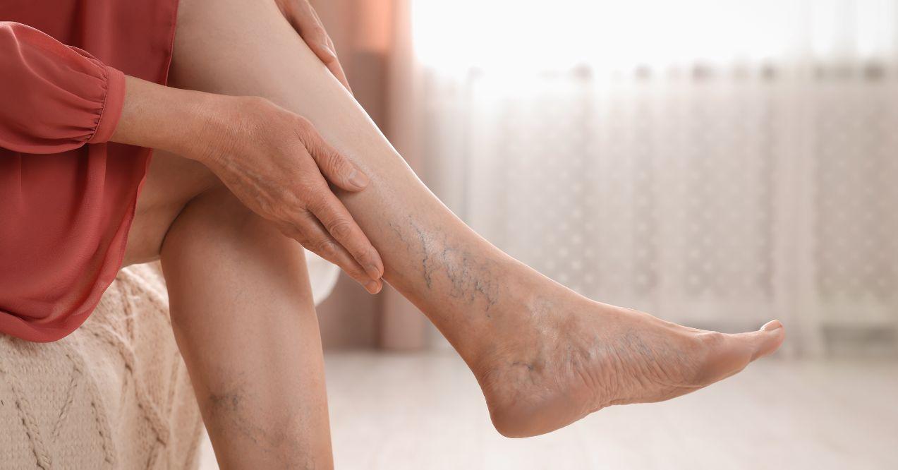 woman is holding her hand on her shin and showing a spider vein