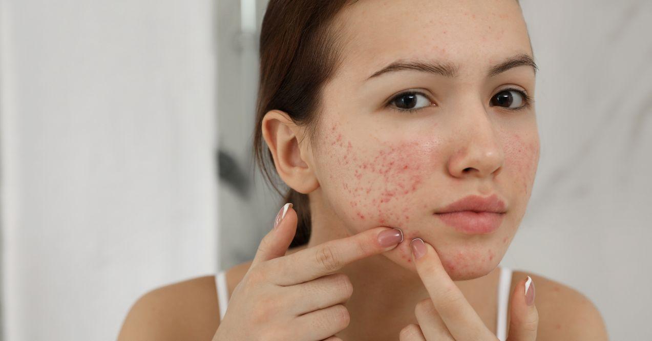 a woman with acne is popping a pimple