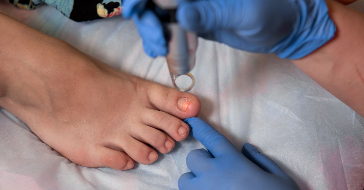 a doctor applying a laser treatment to a toenail, showing detailed view of the infected toenail and the laser device
