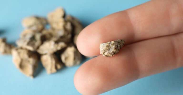 How Can Kidney Stones Cause Gas and Bloating in the Stomach