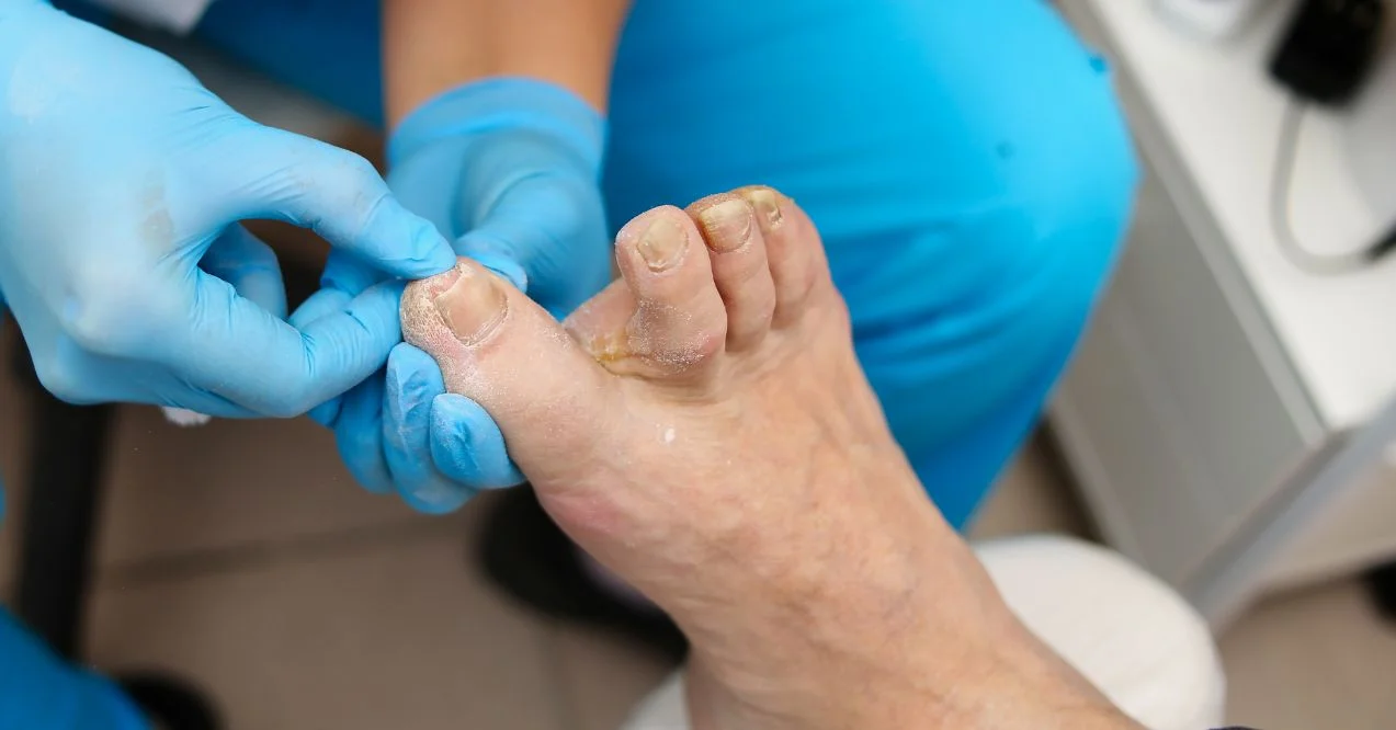 close-up of a doctor examining and treating severe toenail fungus on an elderly patient's foot in a medical office