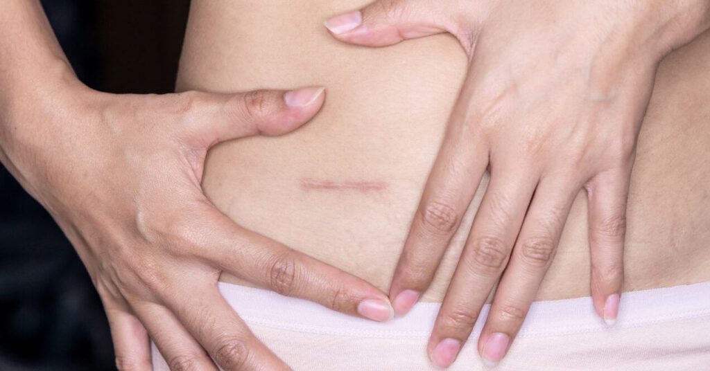 Woman showing her stomach with a scar.