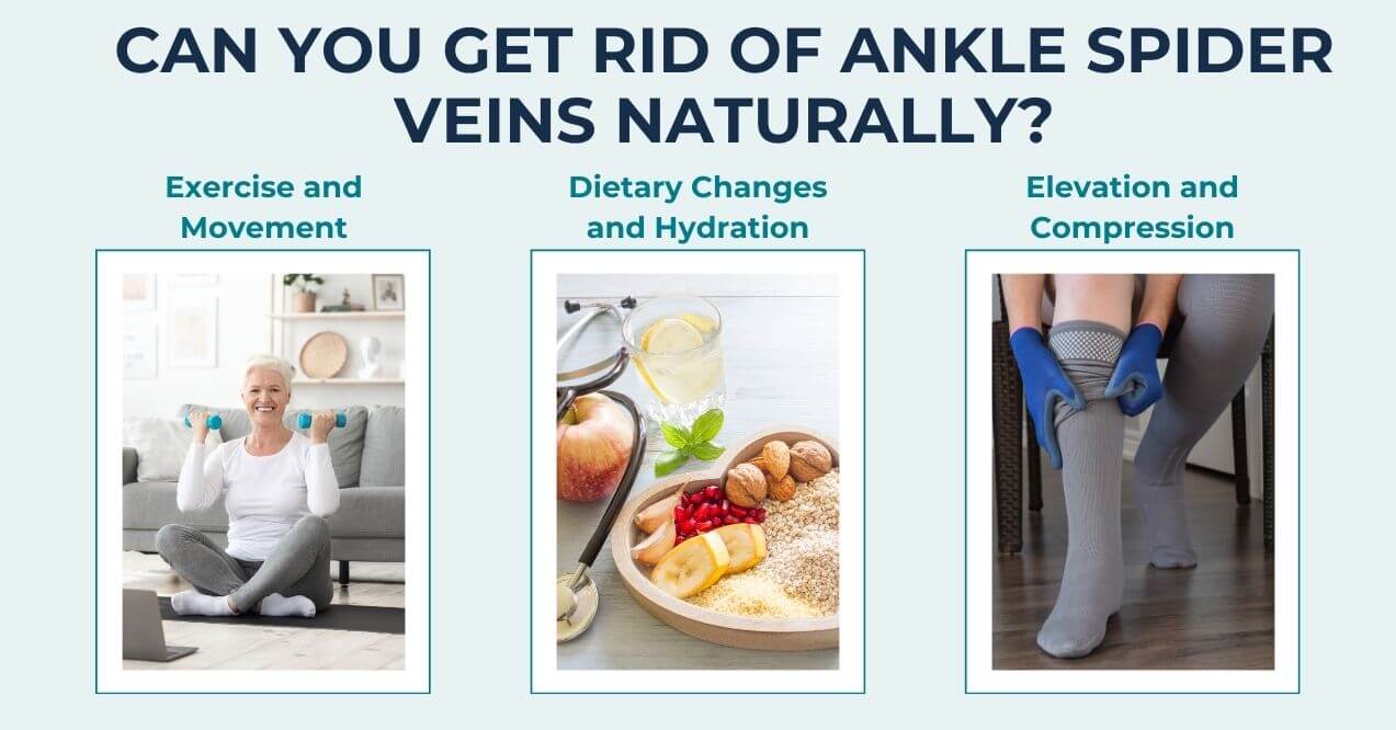 Infographic titled 'Can You Get Rid of Ankle Spider Veins Naturally?' featuring three natural methods: Exercise and Movement, Dietary Changes and Hydration, and Elevation and Compression