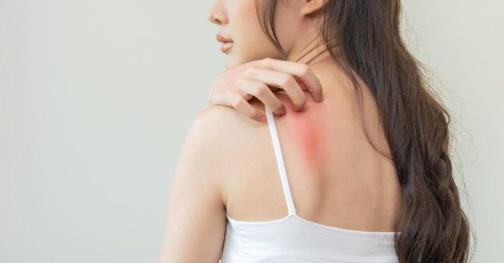 Woman scratching her back where there is visible redness, showing skin irritation.