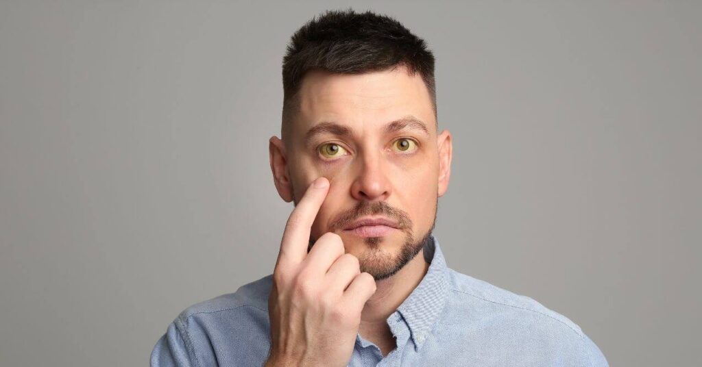 Man with yellow discoloration in the eyes, a symptom of jaundice.