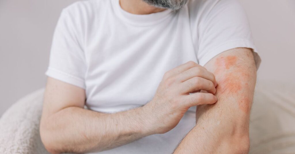 Man scratching his arm, which has visible red patches, indicating a rash or skin irritation.