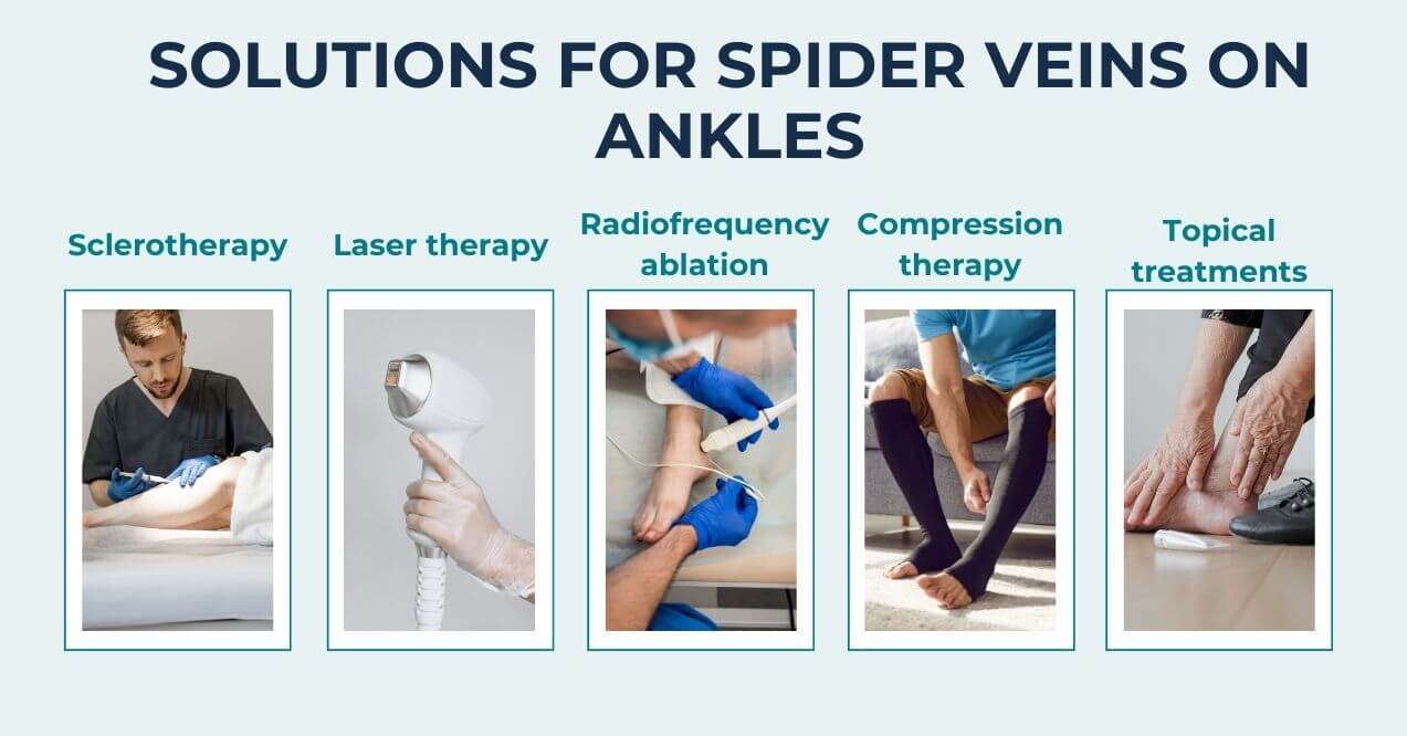 Infographic titled 'Solutions for Spider Veins on Ankles,' showing five treatments: Sclerotherapy, Laser Therapy, Radiofrequency Ablation, Compression Therapy, and Topical Treatments