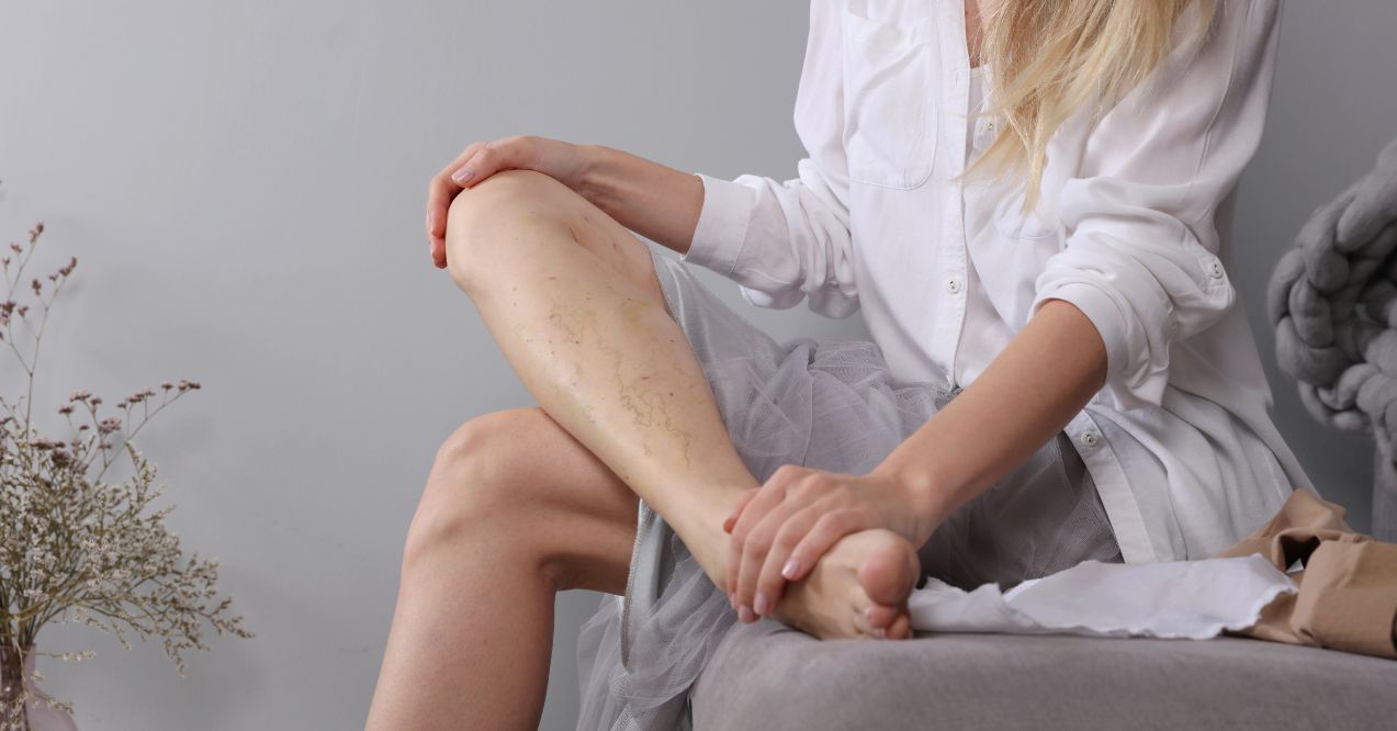 Woman sitting on a bed examining her legs, showing visible spider veins on her ankle.