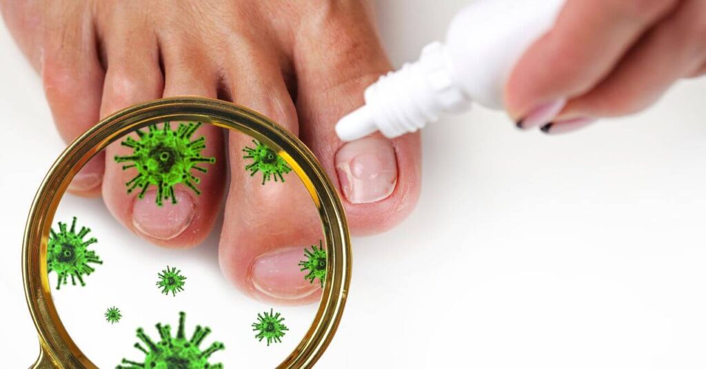 A close-up of toes with a magnifying glass showing green germs, while an antifungal solution is being applied to one toenail.