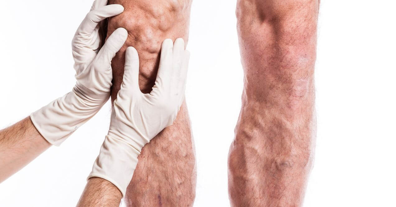 Doctor examining a patient's swollen leg with gloved hands