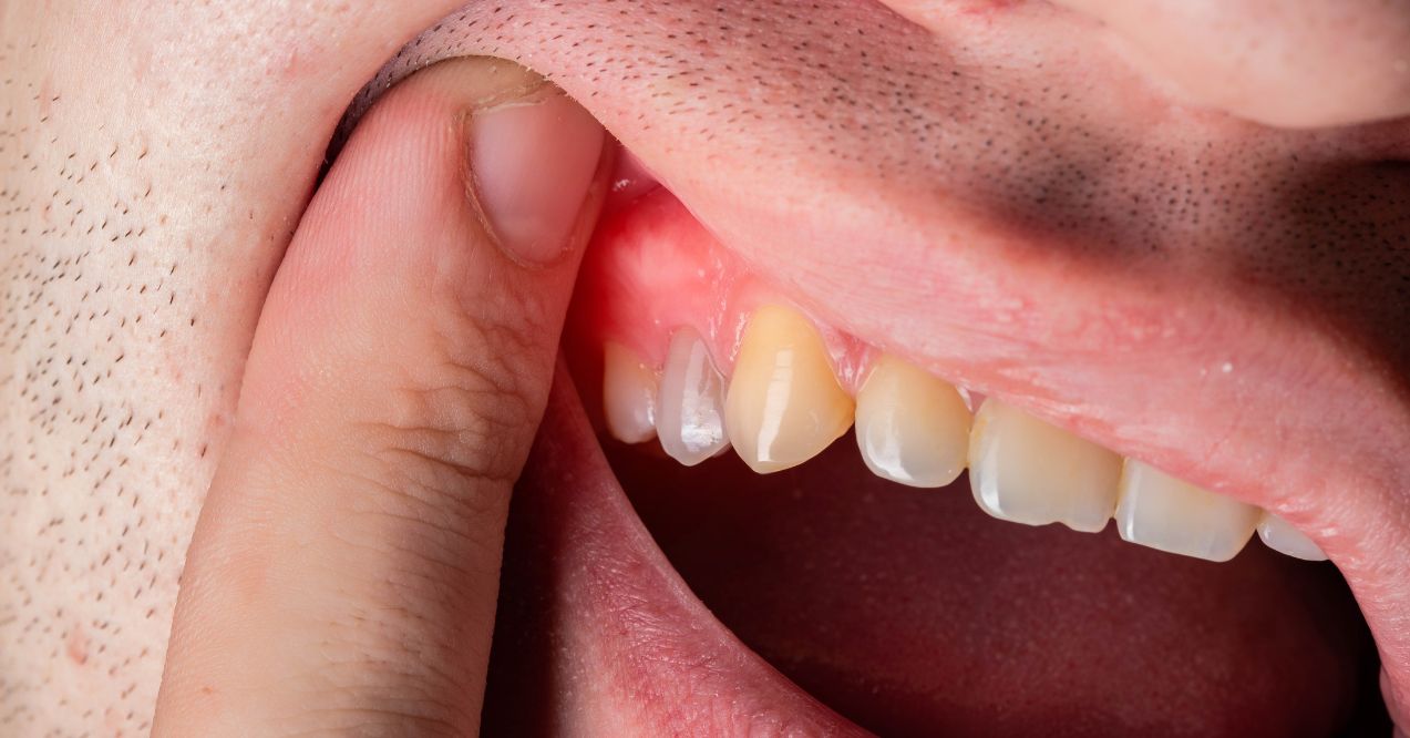 A close-up of a gum abscess causing redness and swelling around a tooth.