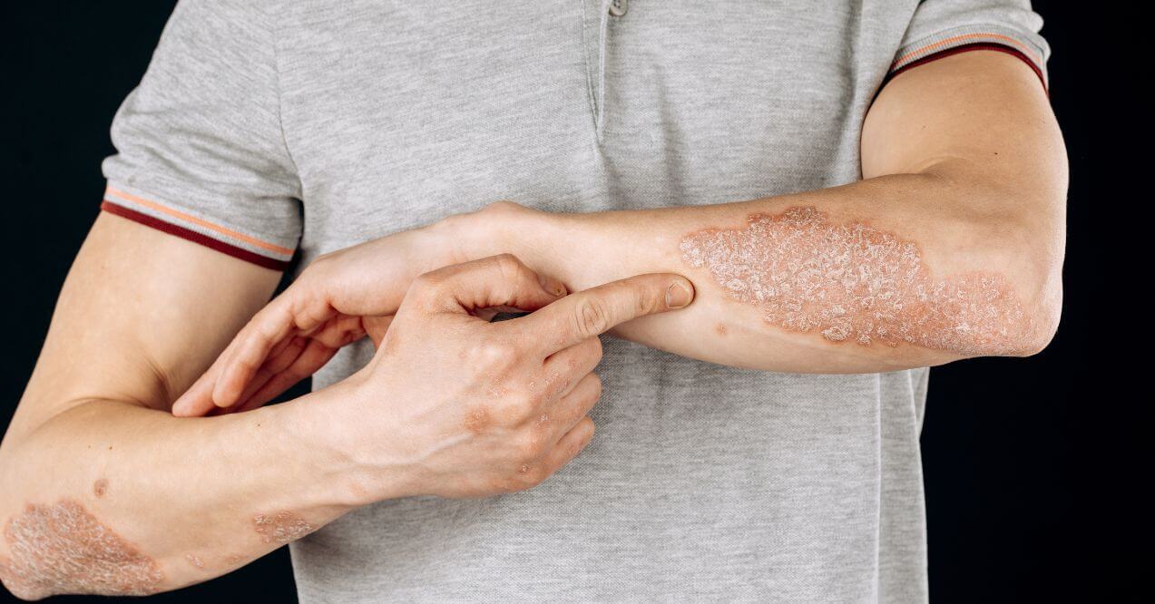 Man pointing at dry, flaky skin patches on his arm, related to autoimmune conditions.