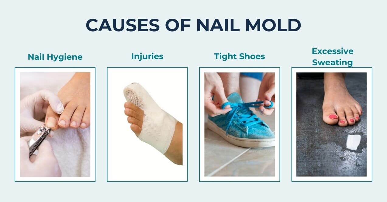 Nail mold causes: poor hygiene, injuries, tight shoes, excessive sweating.