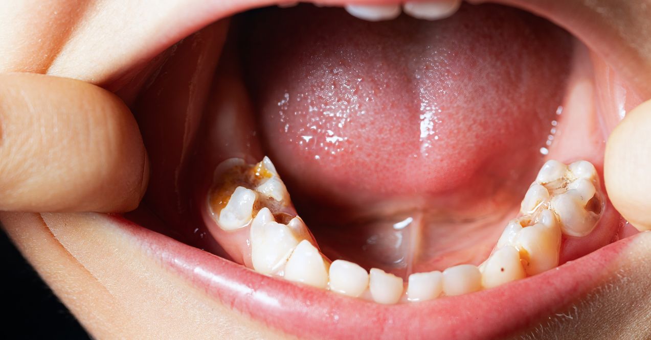 A close-up of decayed molars with visible cavities and damage.