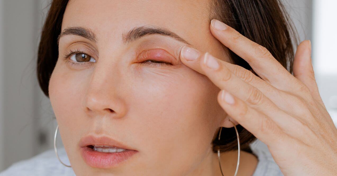 Woman touching her swollen upper eyelid, indicating an eye infection.