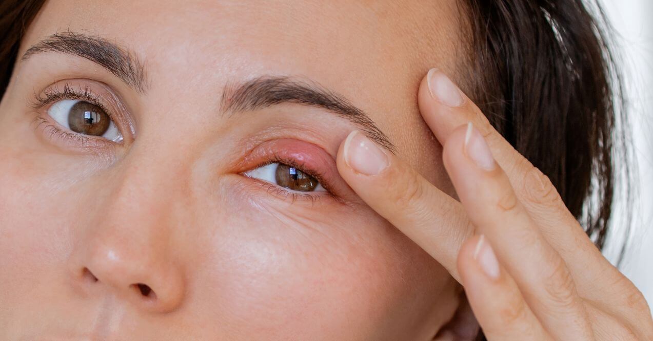 A close-up of an eye with redness, showing signs of an eye infection.