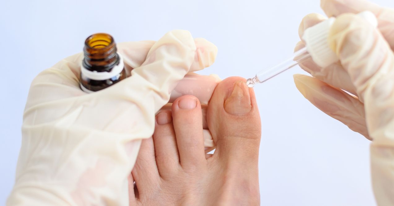 Can I Use Hydrogen Peroxide for Toenail Fungus?