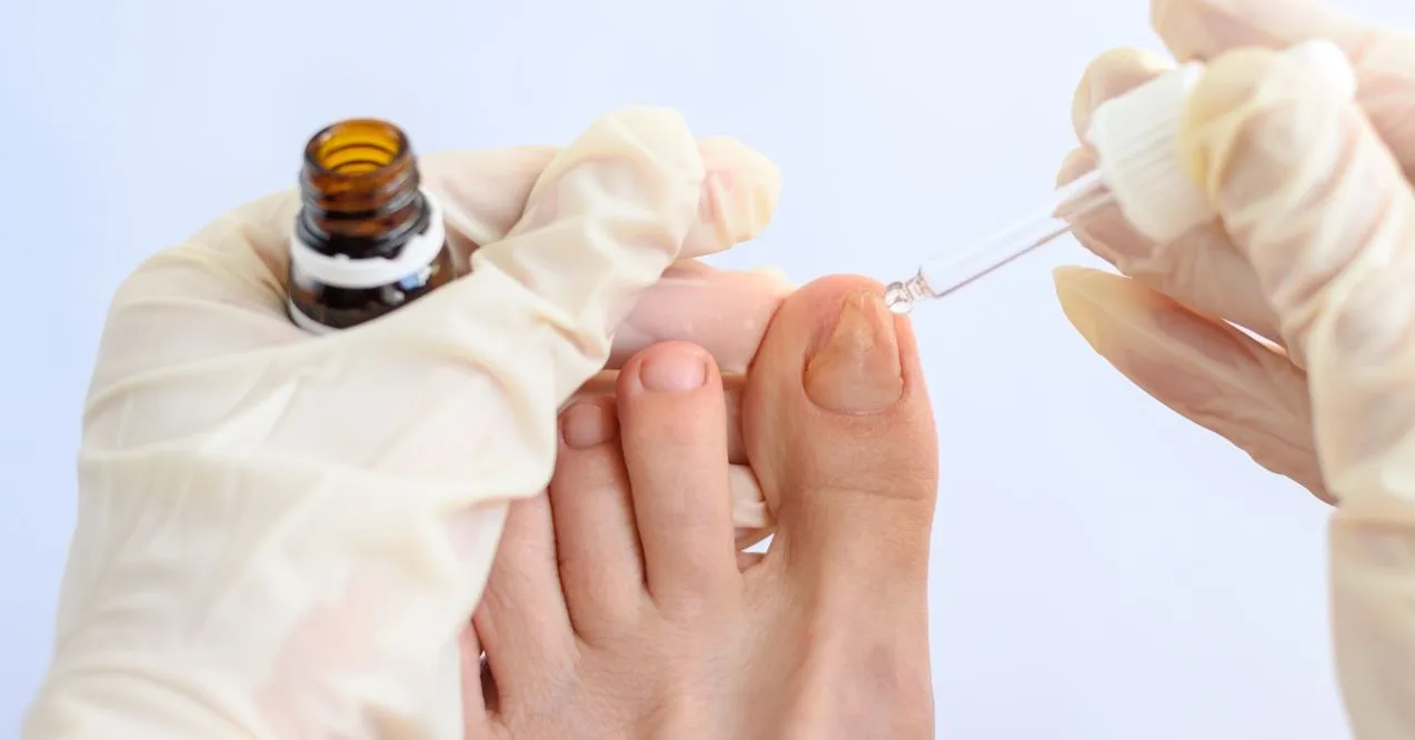 Applying hydrogen peroxide for toenail fungus treatment with a dropper on an infected toenail.