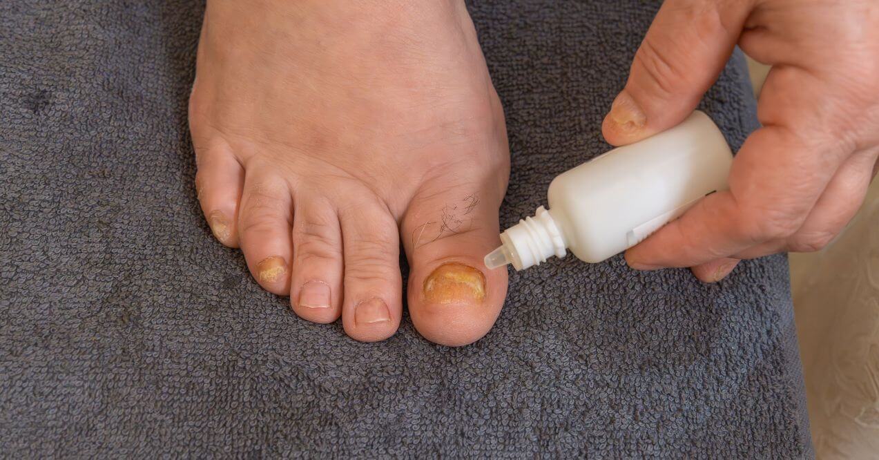 Applying antifungal treatment to toenails on a towel.