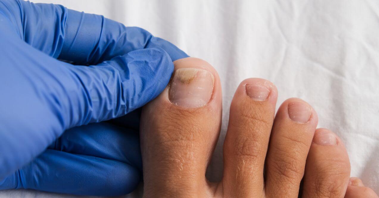 Close-up of toenail affected by nail fungus with gloved hand examining the nail.