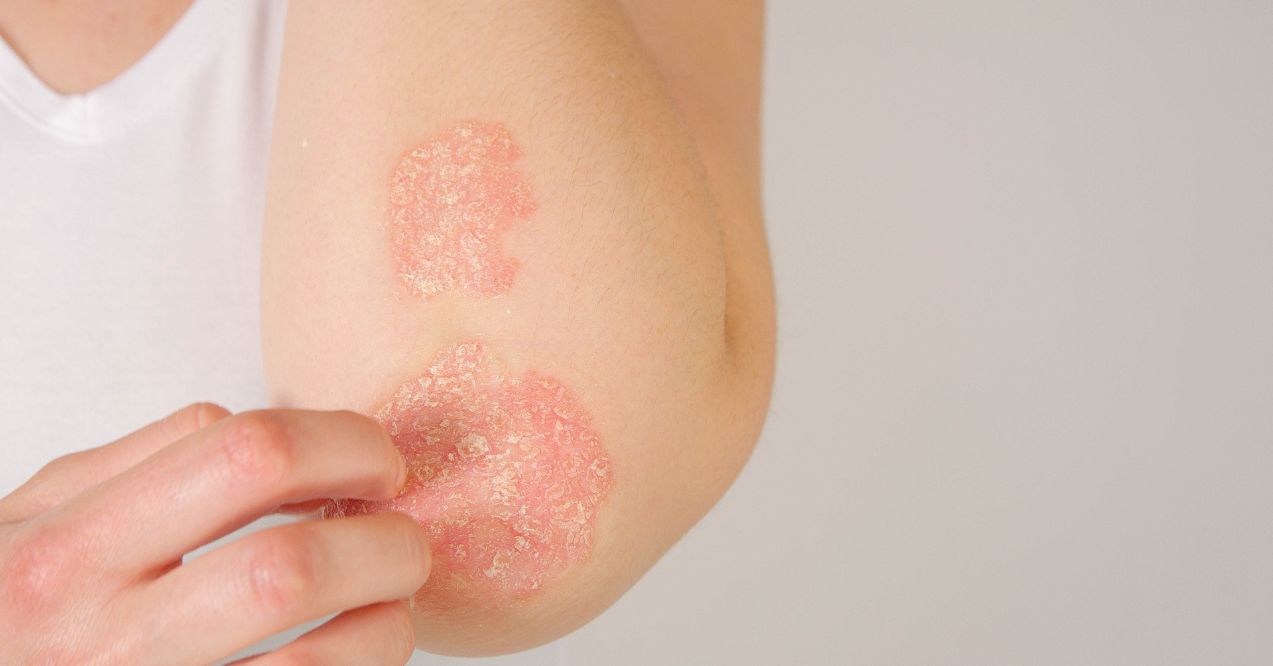 A person scratching a rash on their elbow with visible dry and irritated skin.