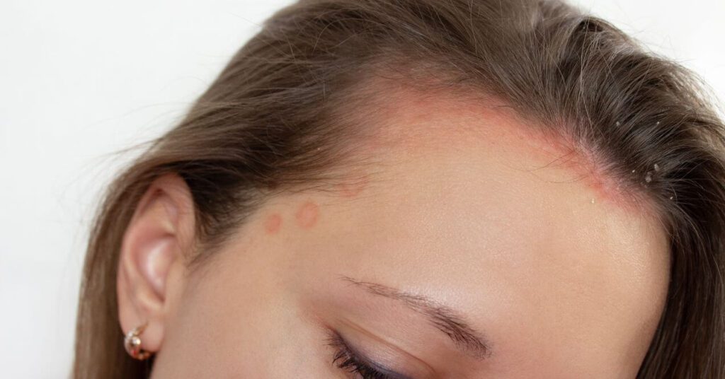 Close-up of a woman’s scalp with visible red patches indicating a possible scalp infection.