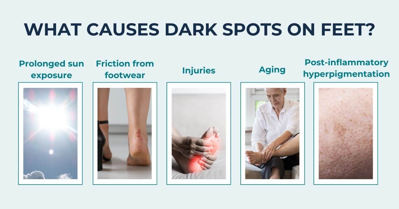 Causes of dark spots on feet: sun exposure, footwear friction, injuries, aging, hyperpigmentation.