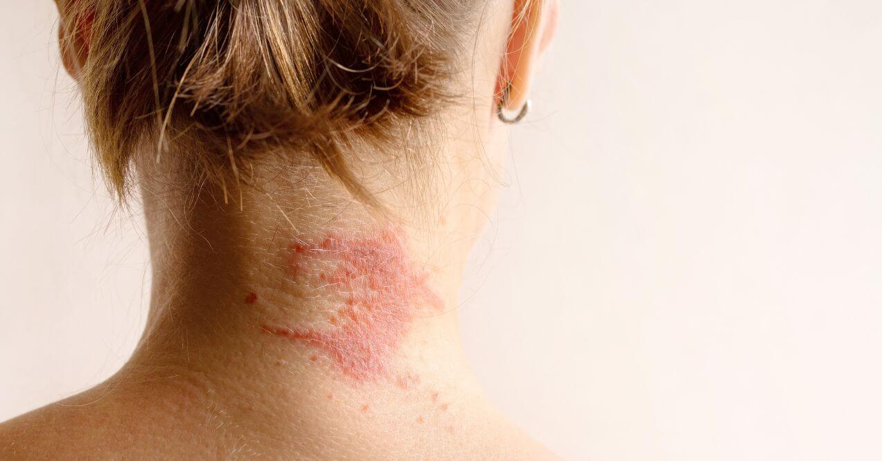 Close-up of an allergic reaction on the back of the neck, showing skin irritation.