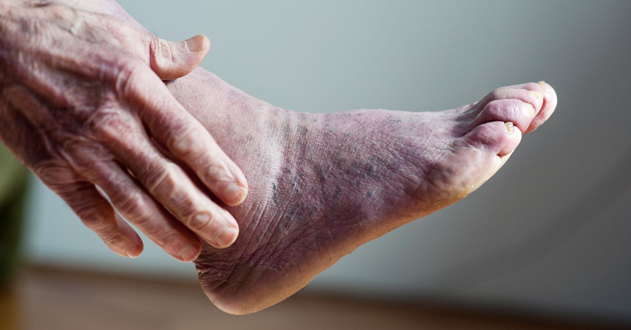 Person gently holding their foot with visible dark spots, showing how to get rid of dark spots on foot.