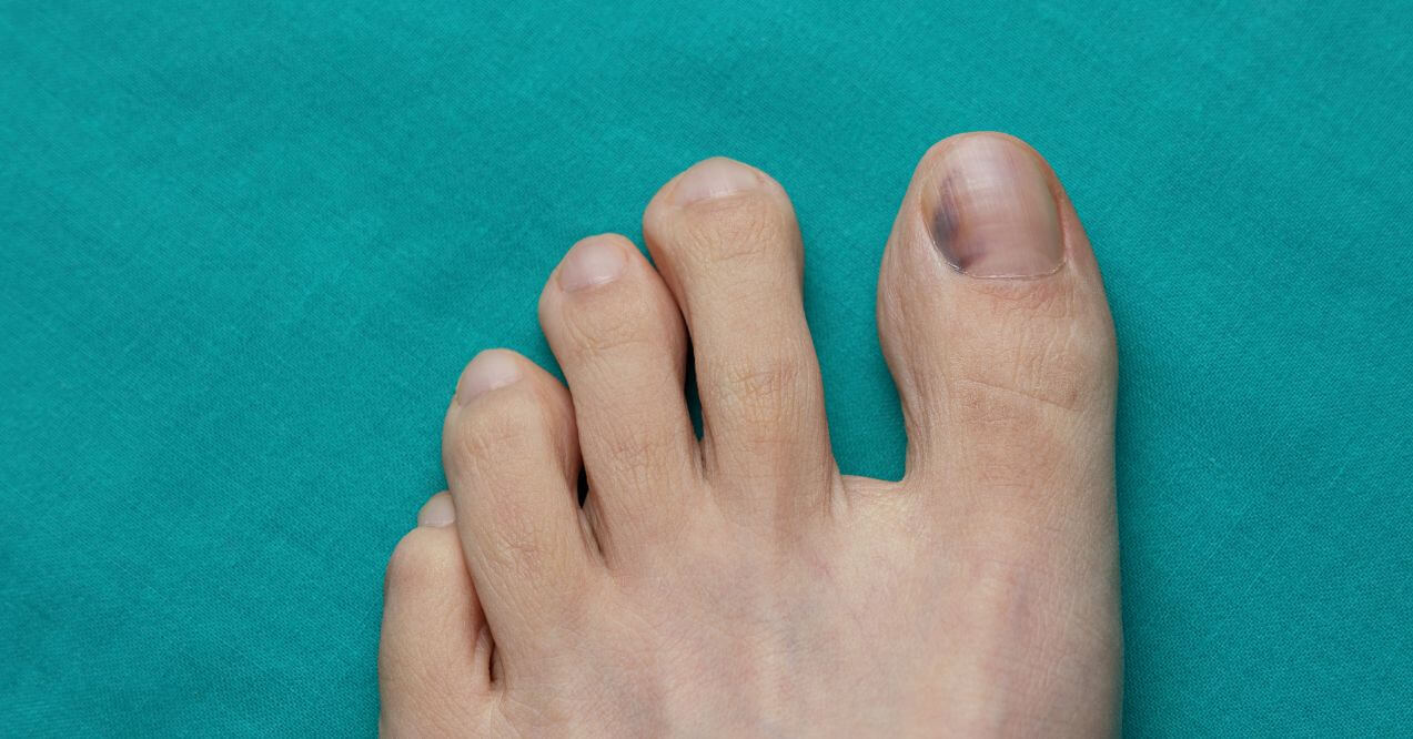 Close-up of a bruised big toenail, asking a question: how to get rid of green nail fungus naturally.