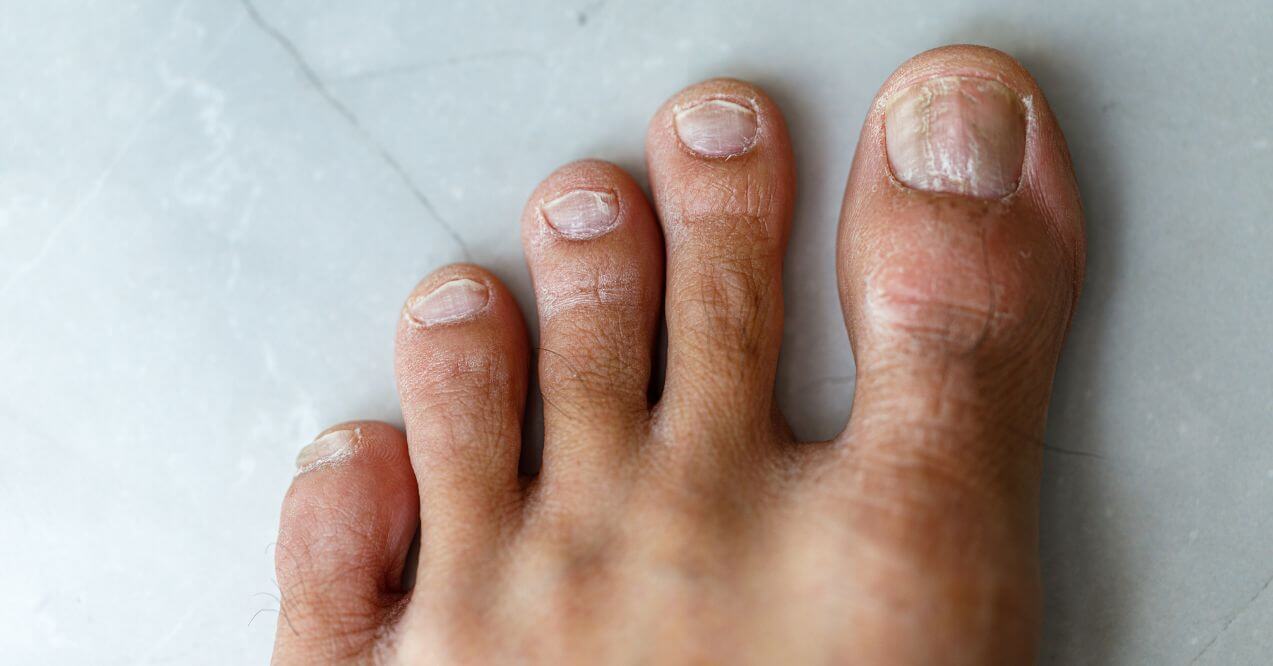 Dry and splitting toenails on a marble floor