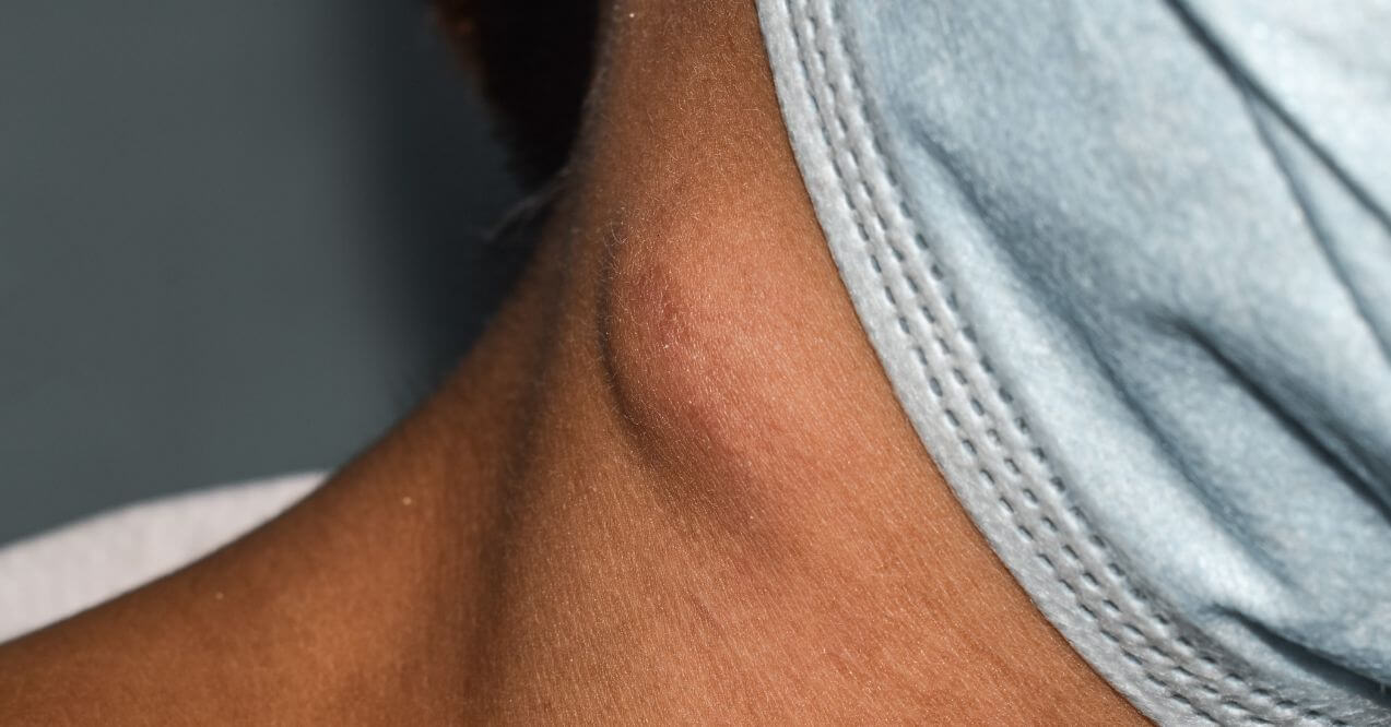 Close-up of a swollen lymph node on the neck area.