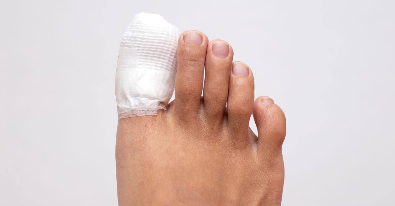 Bandaged toe post-surgery, indicative of toenail issues and recovery care.