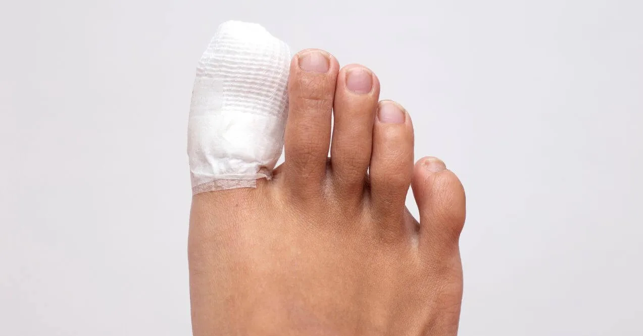 Bandaged toe post-surgery, indicative of toenail issues and recovery care.