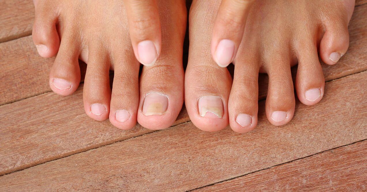 Toenails showing discoloration and damage