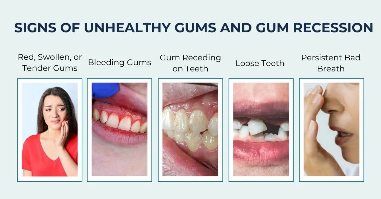 Signs of unhealthy gums: swelling, bleeding, receding gums, loose teeth, and bad breath.