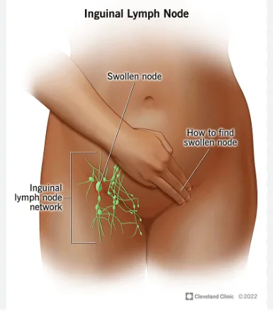 Diagram showing swollen inguinal lymph node in the groin area