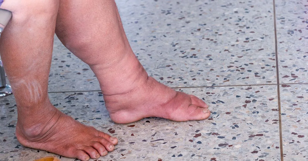 Swollen leg showing signs of lymphedema