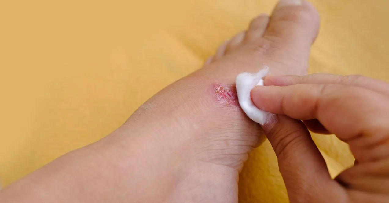 Applying cotton to a foot wound to treat weeping legs.