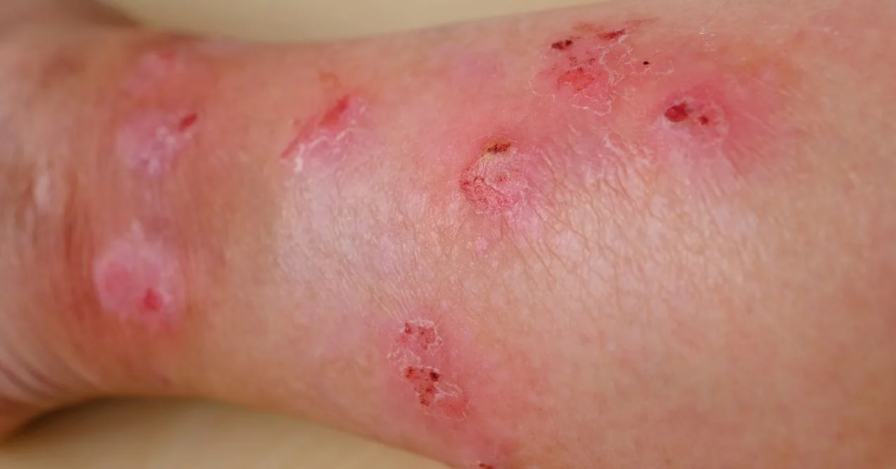 Skin lesions from lymphedema with red patches and sores.