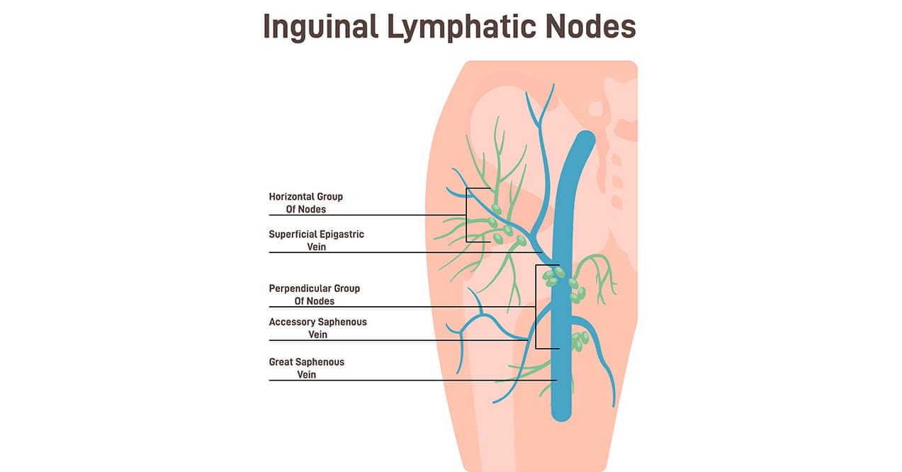 Inguinal lymphatic nodes diagram showing node groups and veins in the groin region.