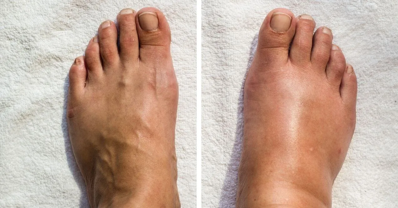 Comparison of lipedema vs lymphedema showing different conditions.
