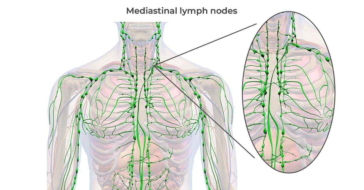 Mediastinal lymph nodes map highlighting lymphatic pathways in the chest and upper body.