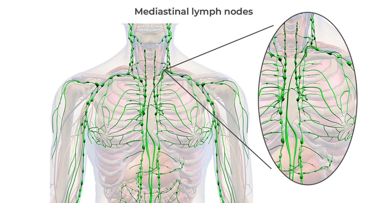 Mediastinal lymph nodes map highlighting lymphatic pathways in the chest and upper body.