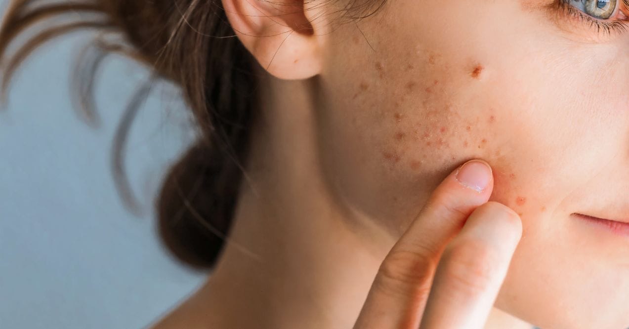 Woman touching acne on cheek resembling the topic: what supplements can cause breakouts