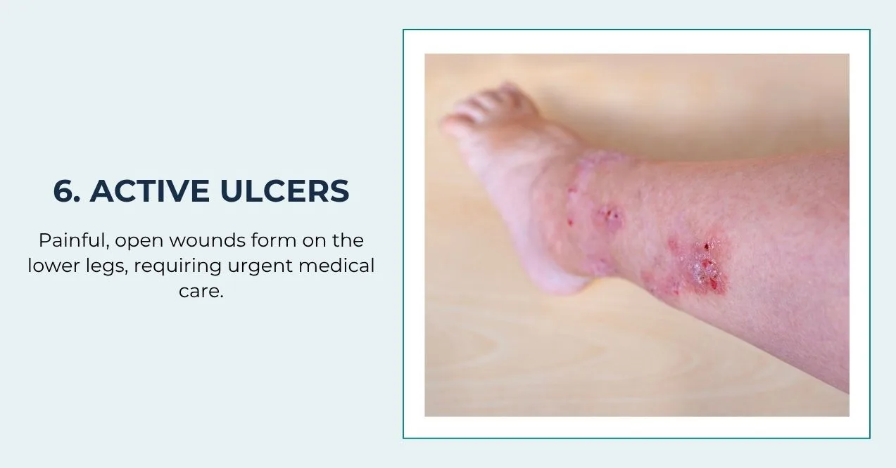 Open, painful leg ulcers with red, inflamed skin.