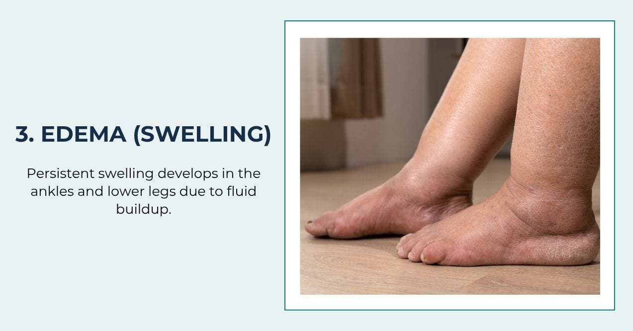 Swollen ankles and feet showing fluid buildup.